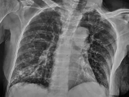 ILO Chest Xray for crystalline silica silicosis medical